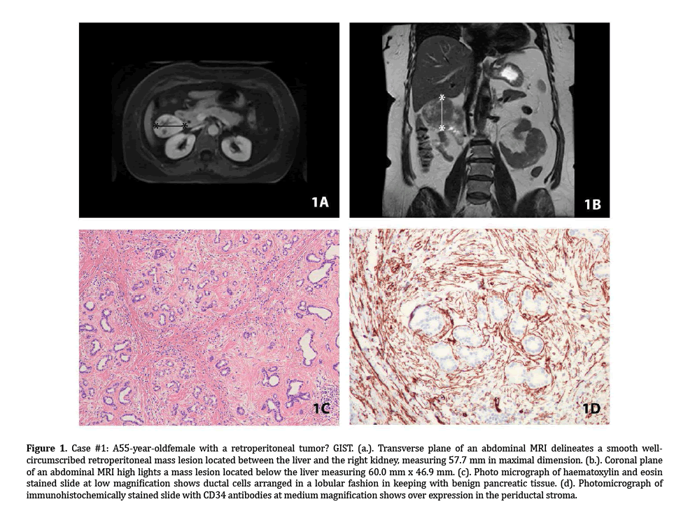 pancreas-retroperitoneal-tumor