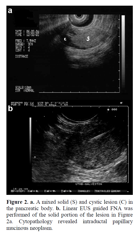 pancreas-revealed-intraductal-papillary