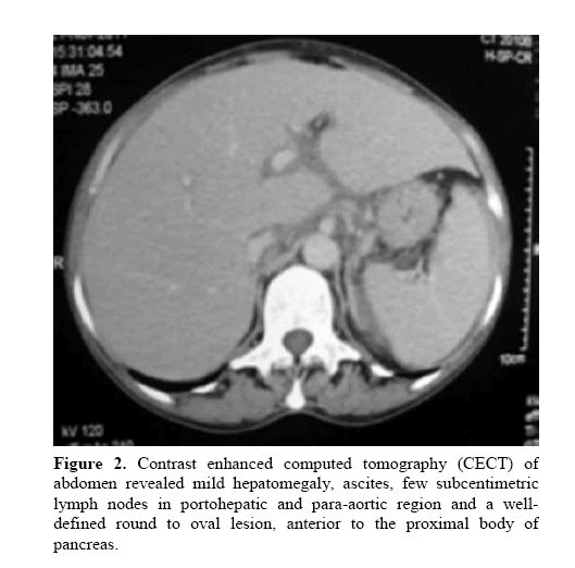 pancreas-revealed-mild-hepatomegaly