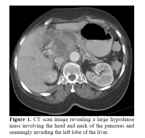 pancreas-revealing-large-hypodense