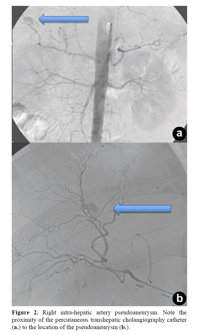 pancreas-right-intra-hepatic-artery