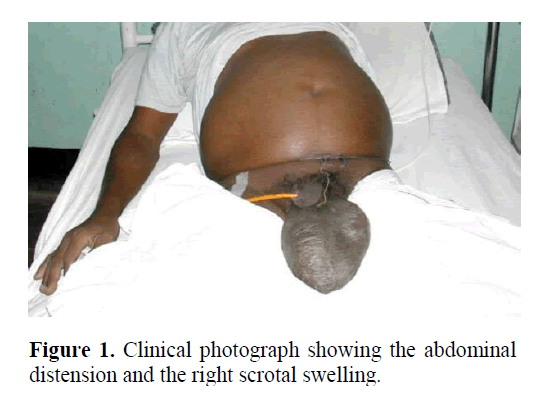 pancreas-right-scrotal-swelling