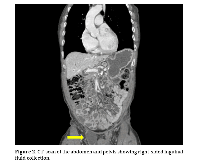 pancreas-right-sided-inguinal