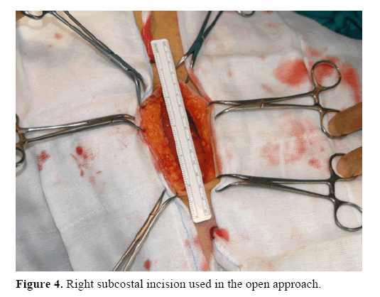 pancreas-right-subcostal-incision