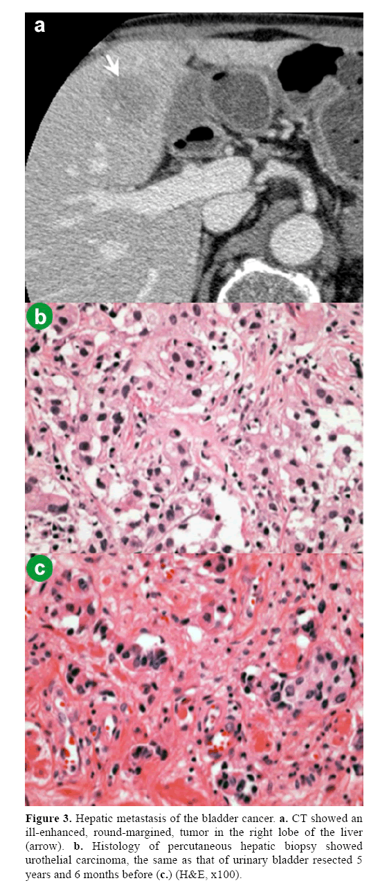 pancreas-round-margined-tumor