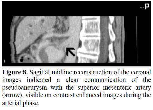 pancreas-sagittal-midline-reconstruction