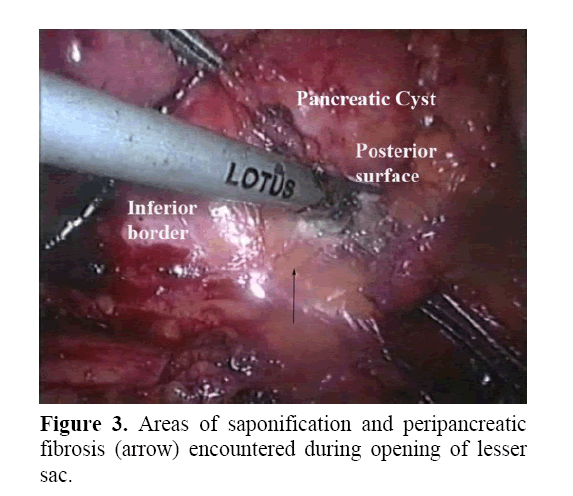 pancreas-saponification-peripancreatic