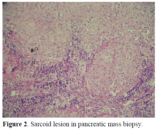 pancreas-sarcoid-lesion-pancreatic