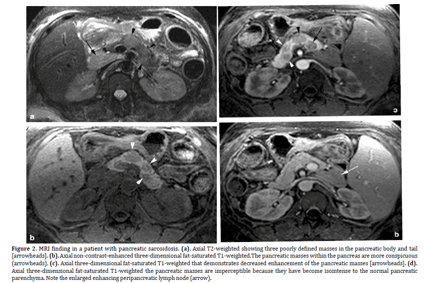 pancreas-sarcoidosis