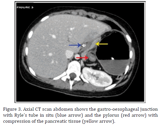 pancreas-scan-abdomen