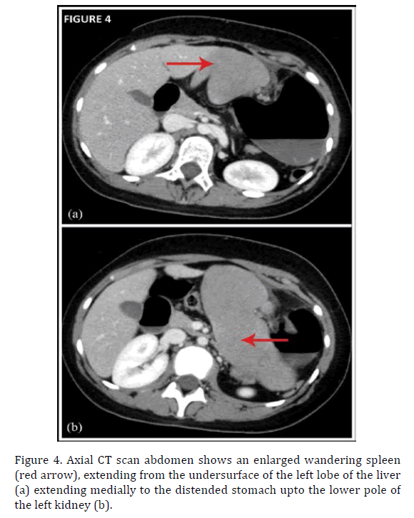 pancreas-scan-abdomen