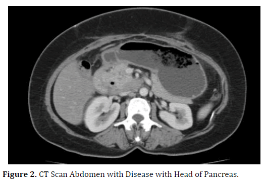 pancreas-scan-abdomen