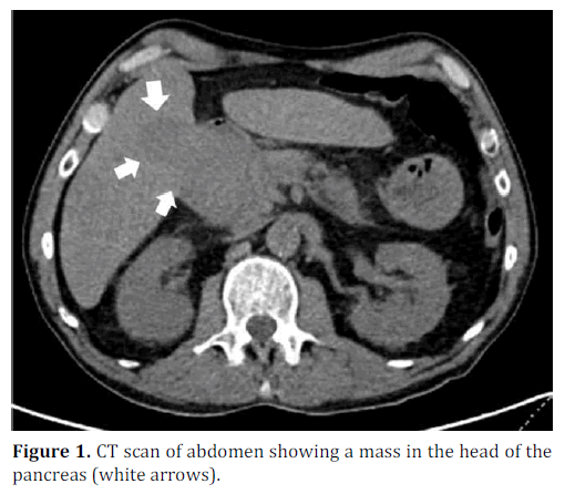 pancreas-scan-abdomen-mass