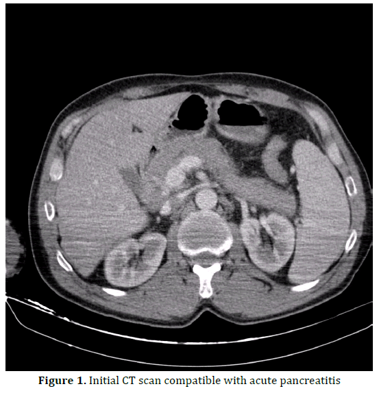 pancreas-scan-acute-pancreatitis