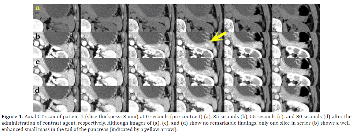 pancreas-scan-patient-pancreas