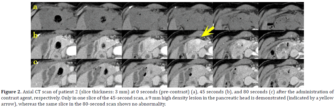 pancreas-scan-patient-pancreas