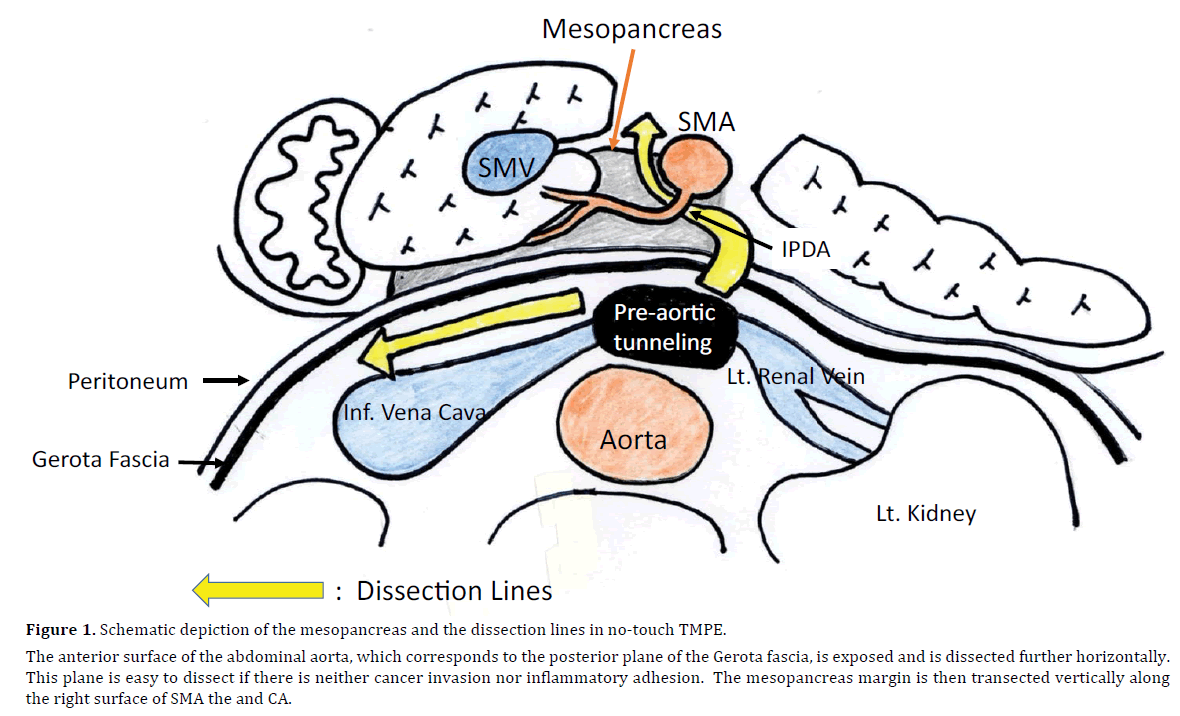 pancreas-schematic-depiction-dissection
