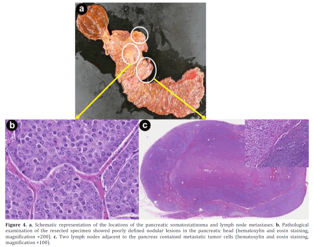 pancreas-schematic-representation