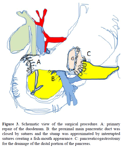 pancreas-schematic-view-procedure