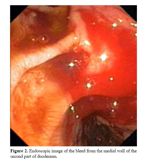 pancreas-second-part-duodenum