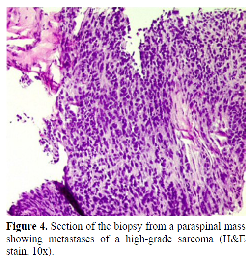 pancreas-section-biopsy-paraspinal-mass
