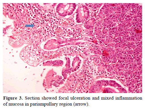 pancreas-section-focal-ulceration-mucosa