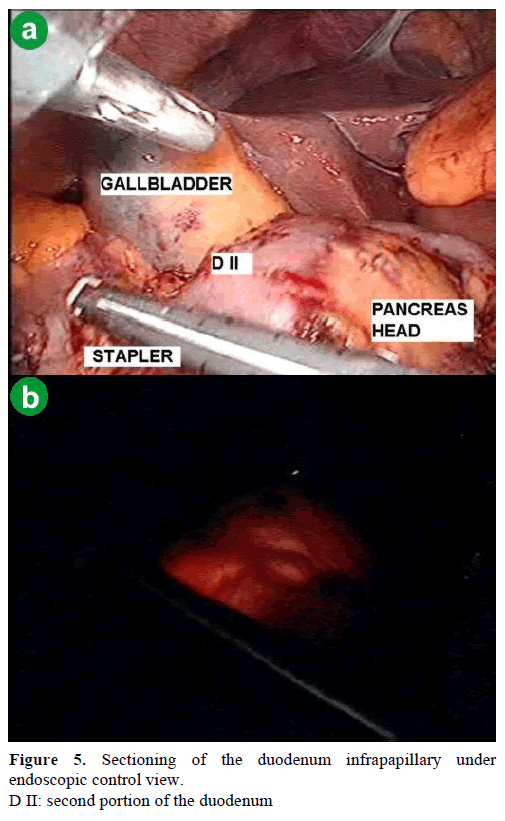 pancreas-sectioning-duodenum-endoscopic