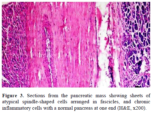 pancreas-sections-pancreatic-mass