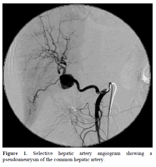 pancreas-selective-hepatic-artery