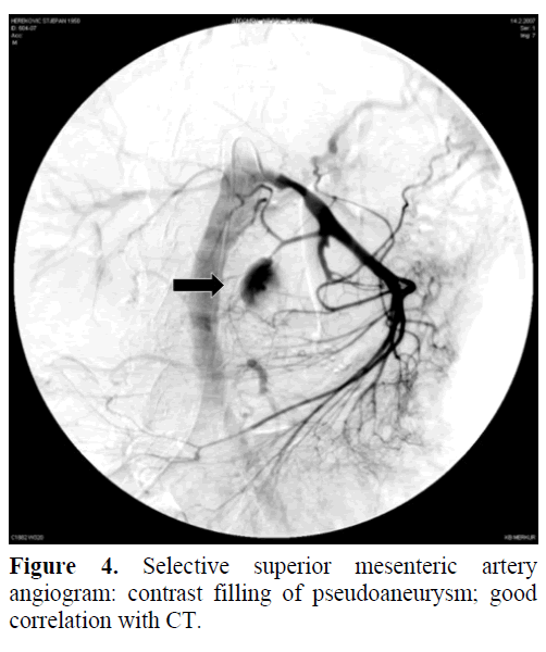 pancreas-selective-superior-mesenteric