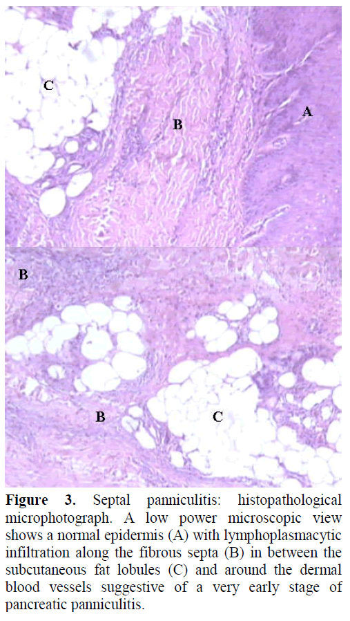 pancreas-septal-panniculitis-microscopic