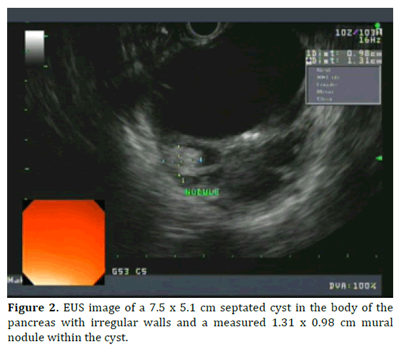 pancreas-septated-cyst-pancreas