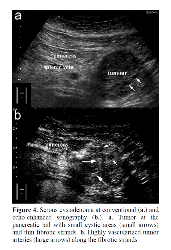 pancreas-serous-cystadenoma-conventional