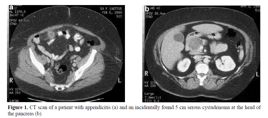 pancreas-serous-cystadenoma-head