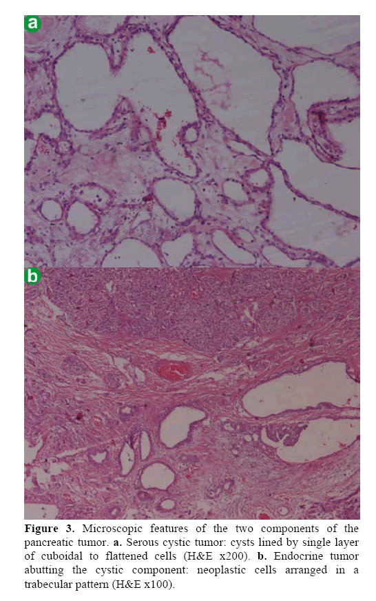 pancreas-serous-cystic-tumor