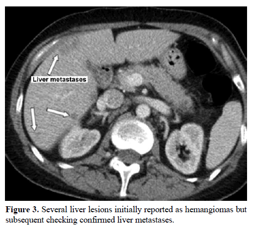 pancreas-several-liver-lesions