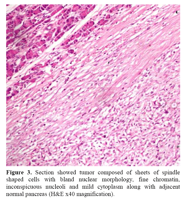 pancreas-showed-tumor-composed