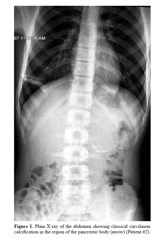 pancreas-showing-classical-curvilinear