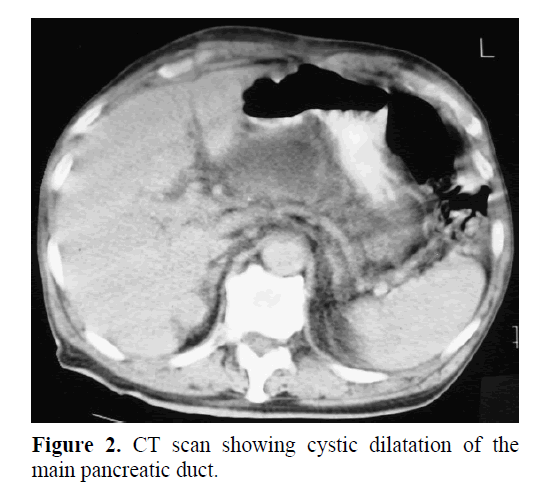 pancreas-showing-cystic-dilatation