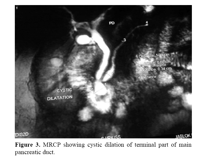 pancreas-showing-cystic-dilation