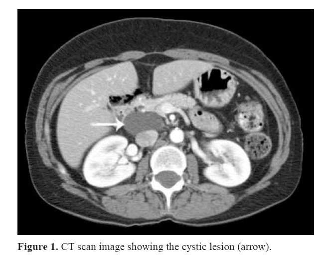 pancreas-showing-cystic-lesion