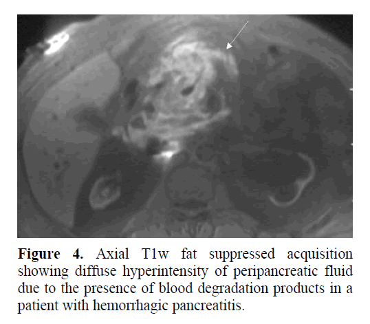 pancreas-showing-diffuse-hyperintensity