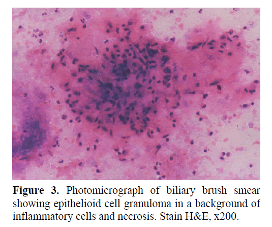 pancreas-showing-epithelioid-cell-granuloma