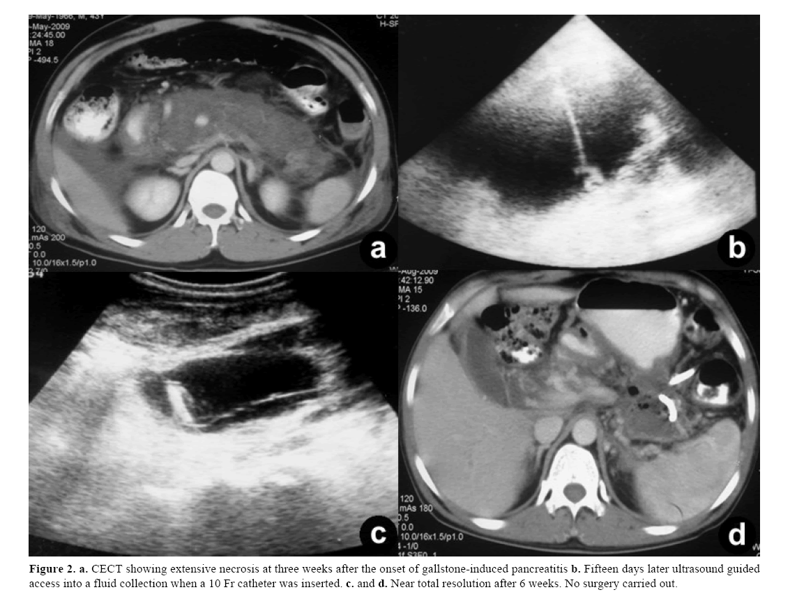 pancreas-showing-extensive-necrosis