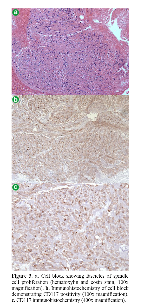 pancreas-showing-fascicles-spindle