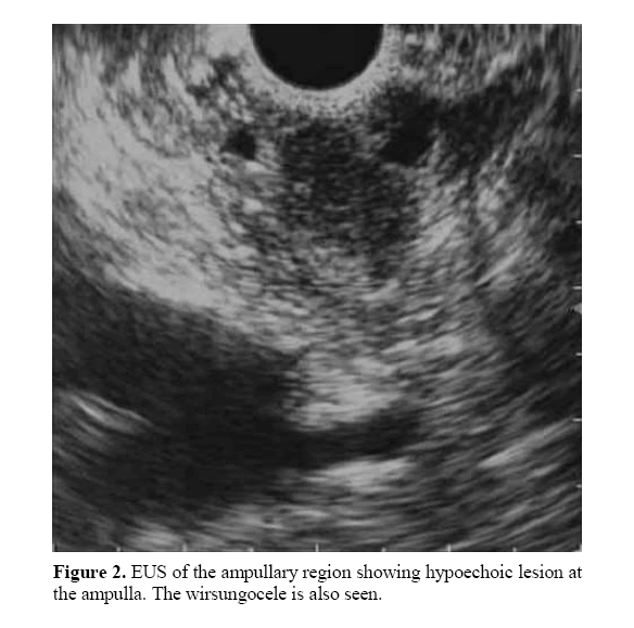 pancreas-showing-hypoechoic-lesion