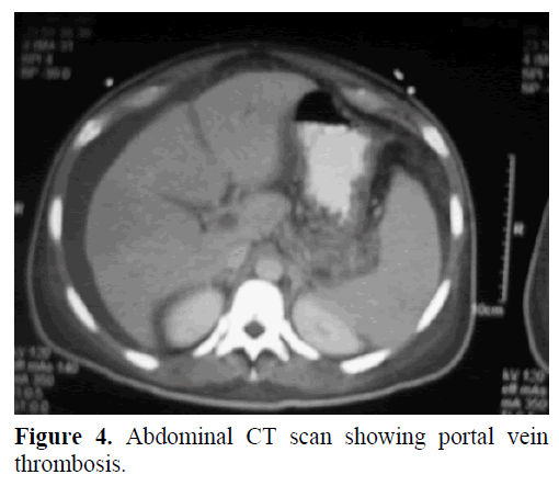 pancreas-showing-massive-thrombosis