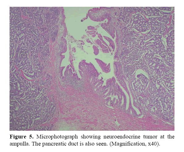 pancreas-showing-neuroendocrine-tumor