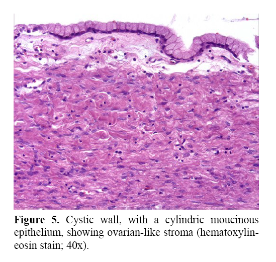 pancreas--showing-ovarian-like-stroma
