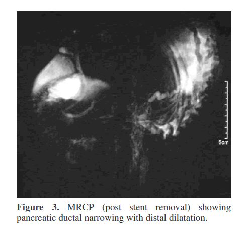 pancreas-showing-pancreatic-duct